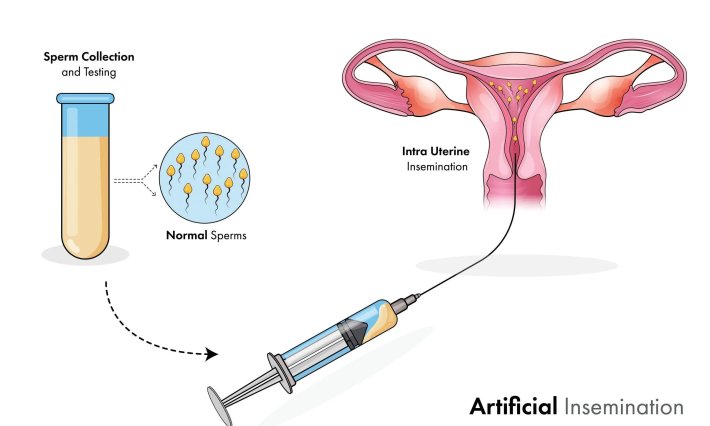 Intrauterine insemination