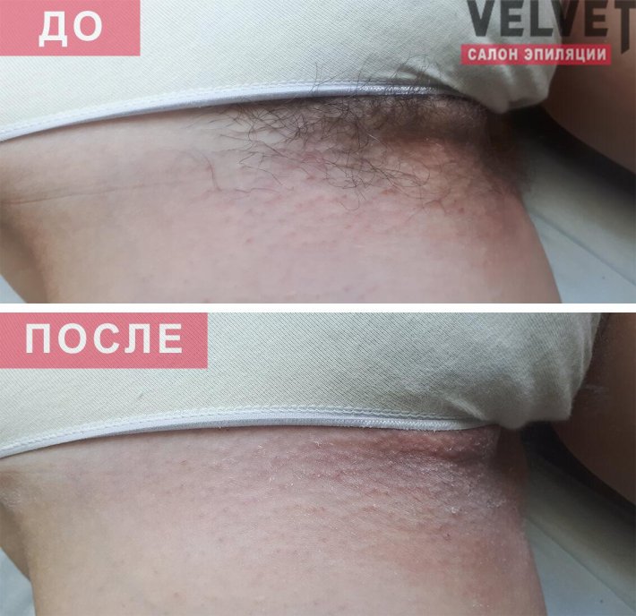Шугаринг глубокое