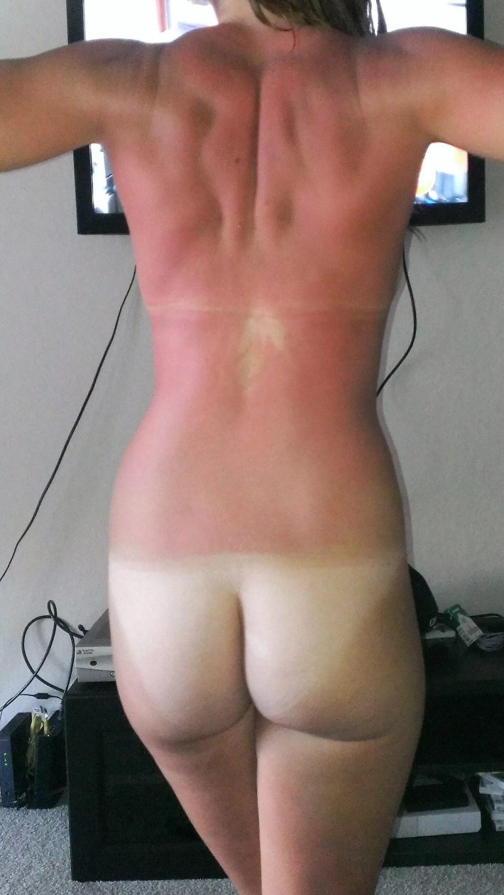 След от загара