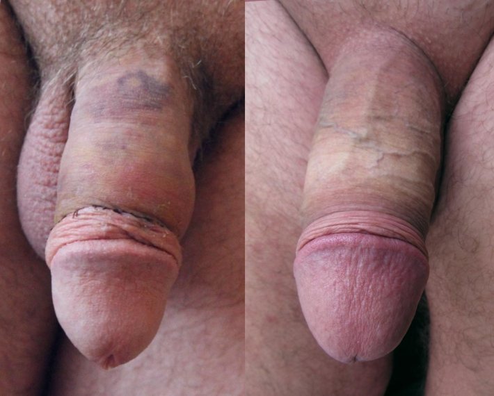 Normal circumcision vs sleeve
