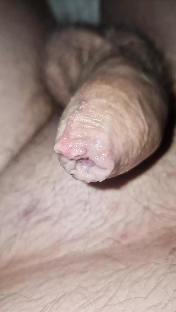 Кератотические кондиломы