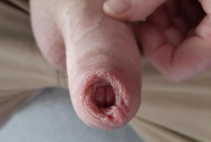 Маленький член крайняя плоть