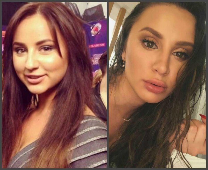Асти анна дзюба до пластики