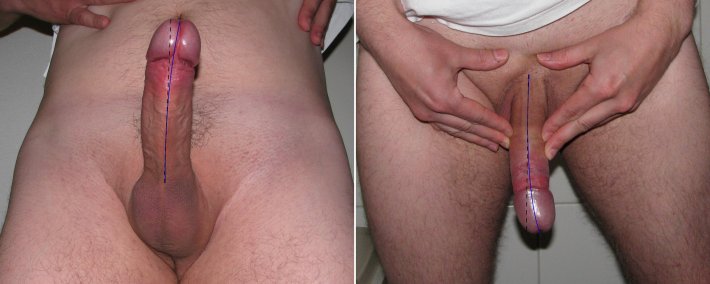 Искривленный половой член